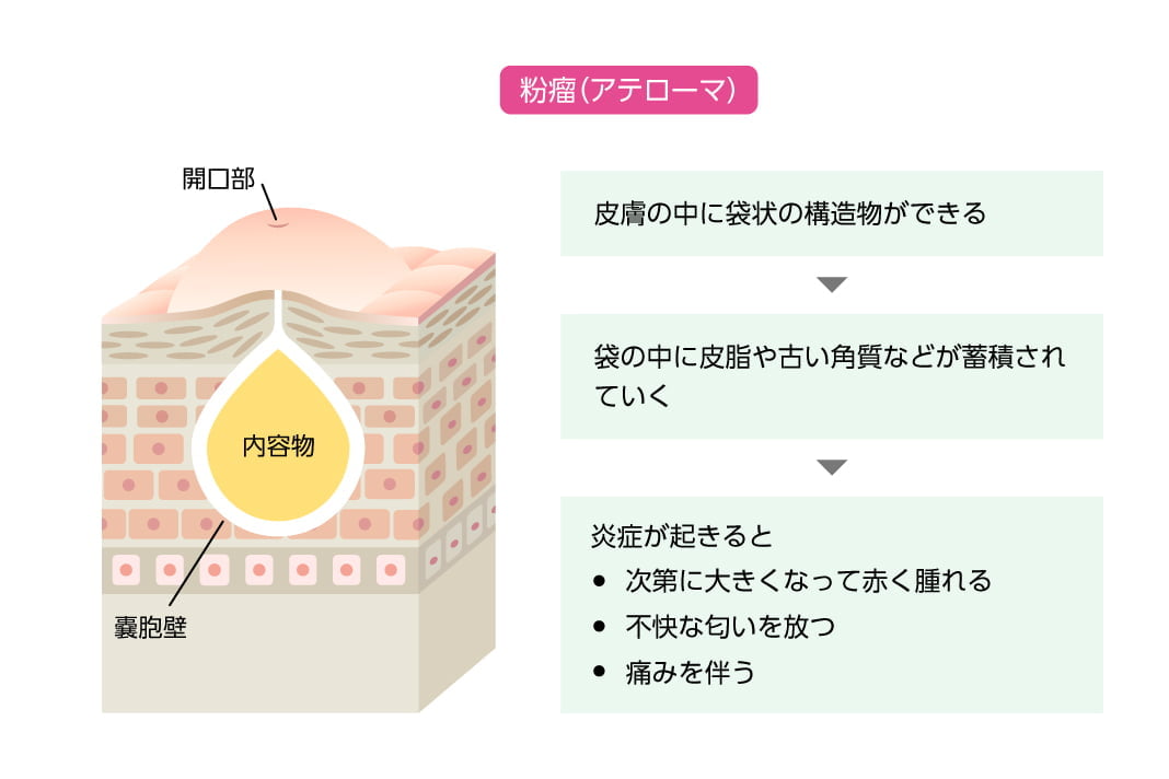 粉瘤(アテローマ)/皮膚の中に袋状の構造物ができる→袋の中に皮脂や古い角質などが蓄積されていく→炎症が起きると、次第に大きくなって赤く腫れる・不快な匂いを放つ・痛みを伴う